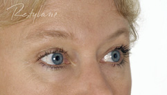 Glabellar Lines - after