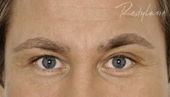 Glabellar lines - after