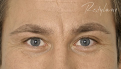 Glabellar lines - before