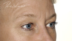 Glabellar Lines - before