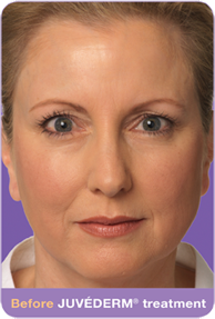 Juvederm