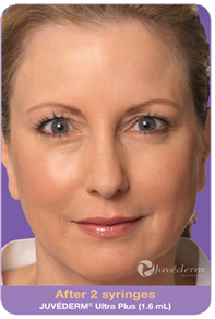Juvederm