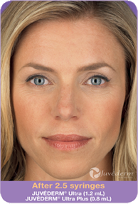 Juvederm
