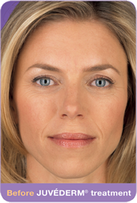 Juvederm