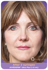 Juvederm