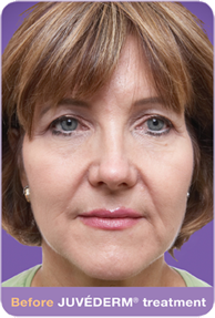 Juvederm