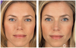 Juvederm Ultra