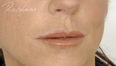 Lips - after