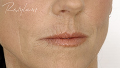 Lips - before
