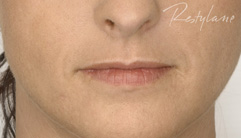 Lips -before