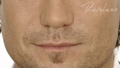 Nasolabial Folds - Before