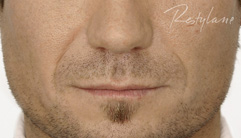 Nasolabial Folds - after