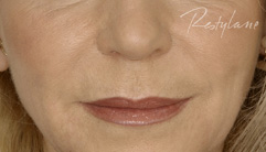 Nasolabial Folds - after
