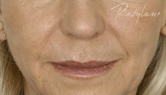 Nasolabial Folds - before